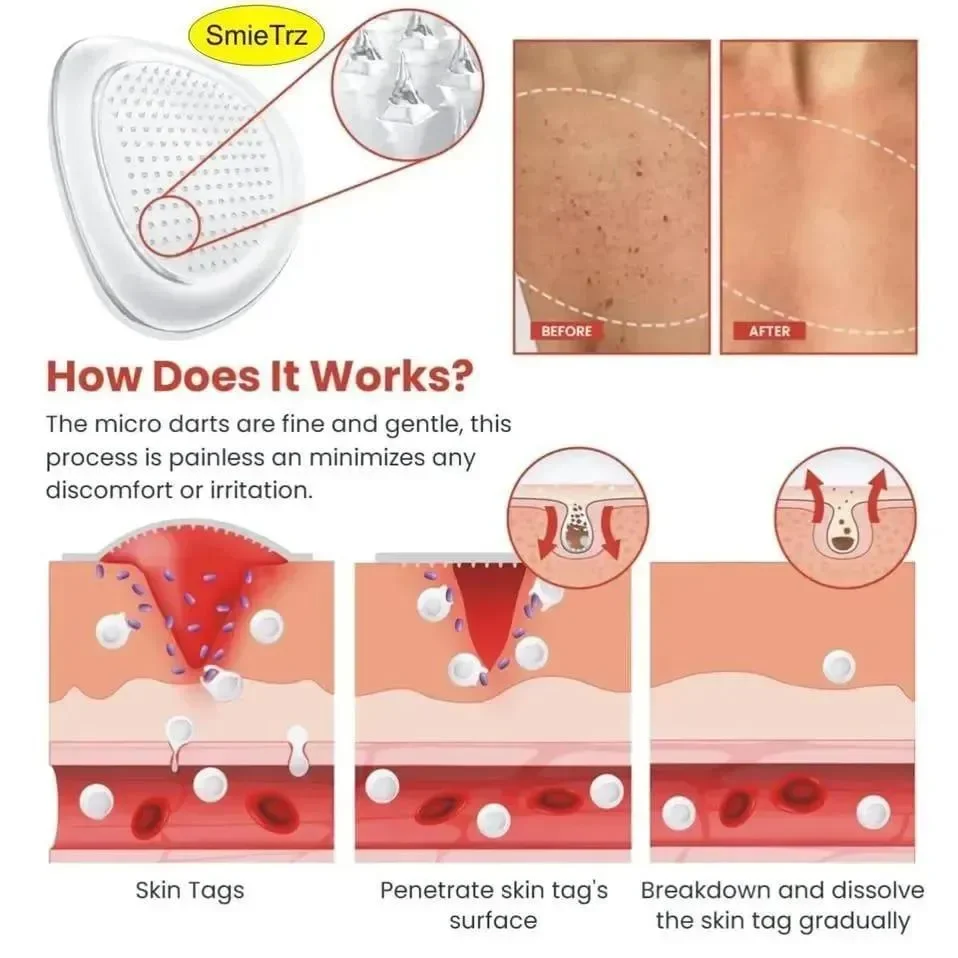 DermaSmooth Skin Tag Remover Patch White 40pcs - Image 2