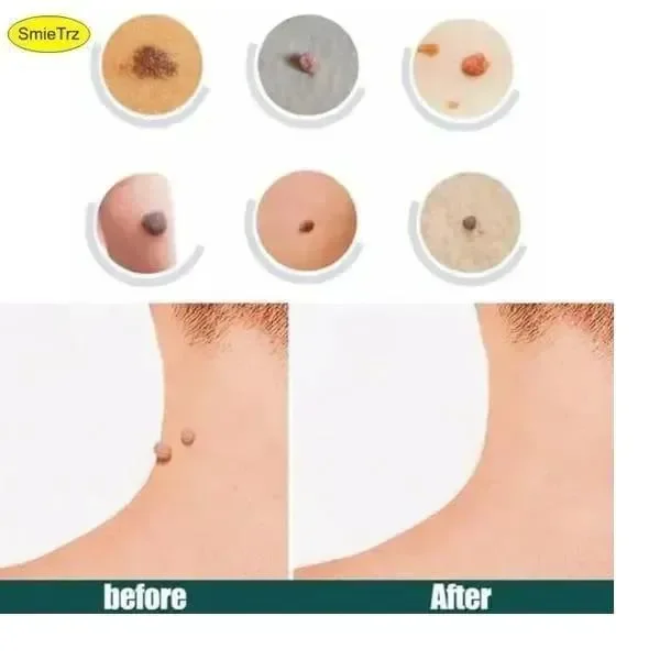 DermaSmooth Skin Tag Remover Patch White 40pcs - Image 4
